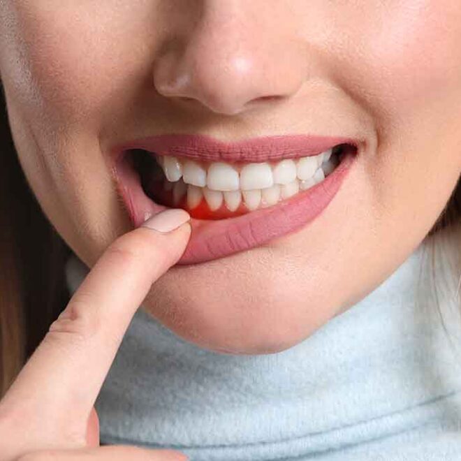 Descubre como la periodontitis puede afectar tu corazón