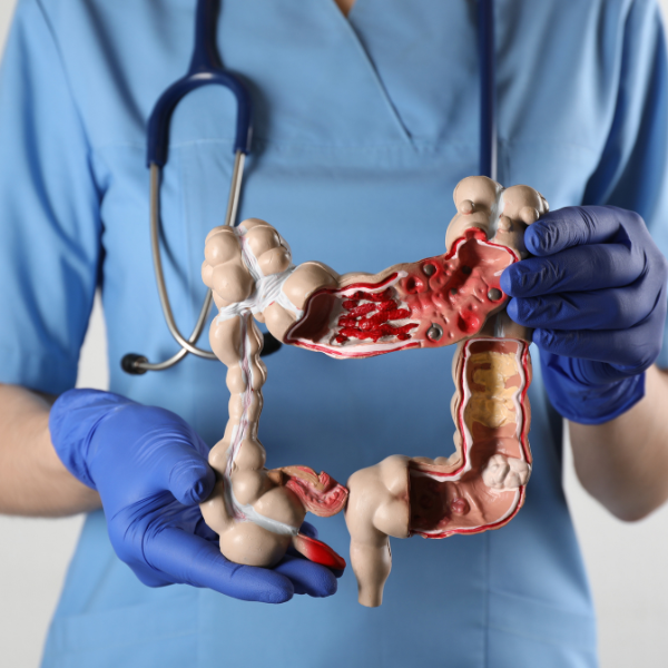 ¿Molestias abdominales frecuentes? Atiéndete, podrían ser señales tempranas de cáncer de colon ¿Molestias abdominales frecuentes? Atiéndete, podrían ser señales tempranas de cáncer de colon