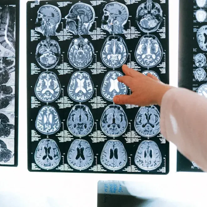 Desarrollan tratamiento para la enfermedad de Huntington Desarrollan tratamiento para la enfermedad de Huntington